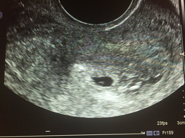 Dating ultrasound 12 weeks