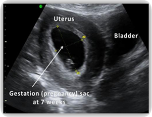 dating ultrasound 12 weeks