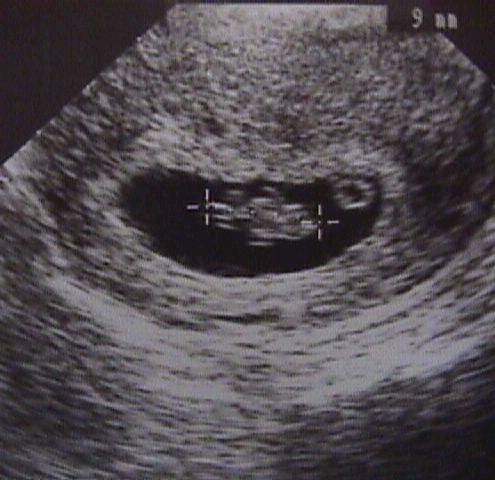 dating ultrasound 12 weeks